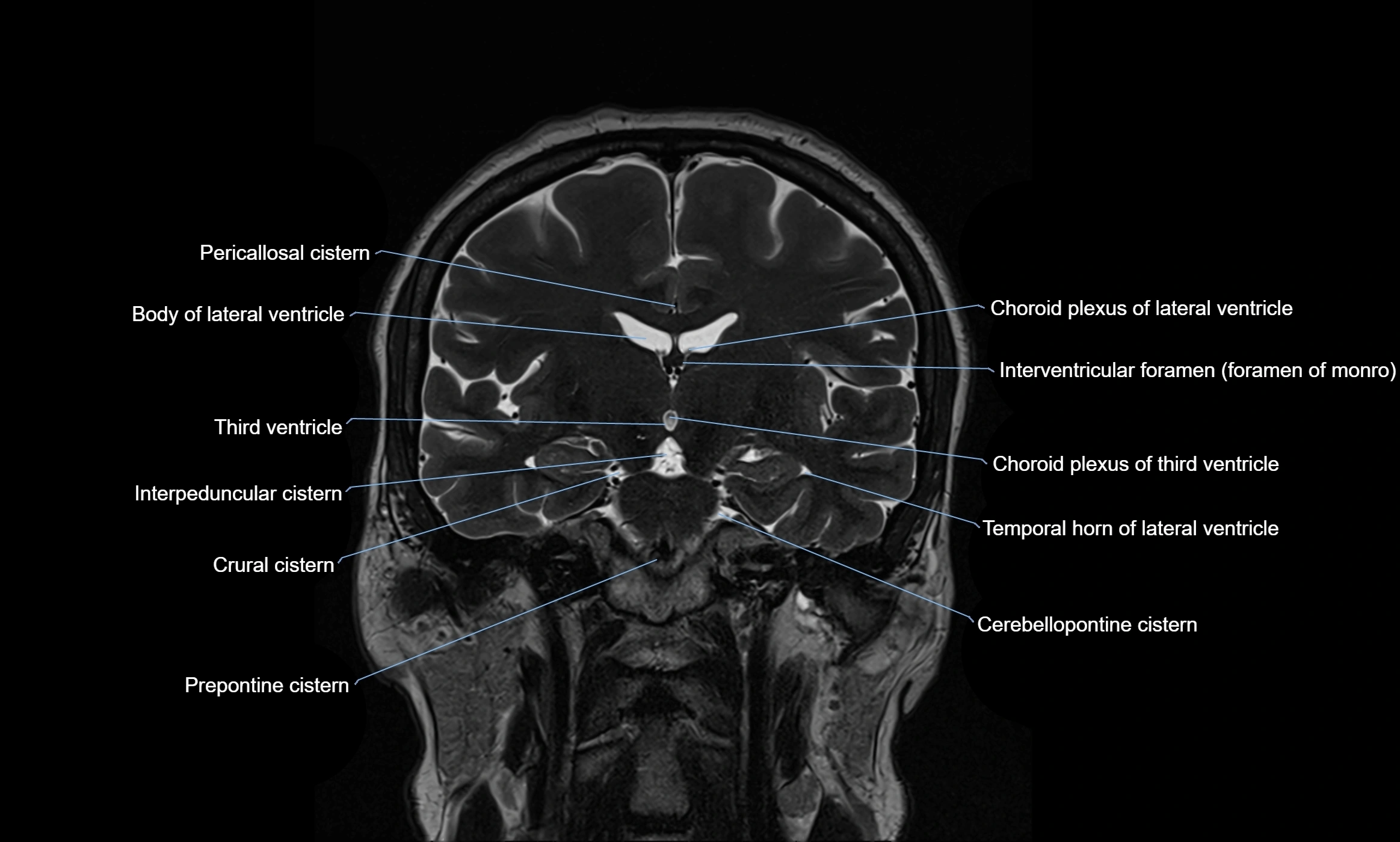 Brain cisterns  and ventricles coronal anatomy 3T MRI image-img-00001-00029.webp
